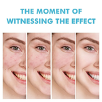 Load image into Gallery viewer, Gel Anti-Acné à l'Acide Salicylique – Une peau plus nette, plus lisse et plus éclatante
