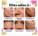 Load image into Gallery viewer, Gel Anti-Acné à l'Acide Salicylique – Une peau plus nette, plus lisse et plus éclatante
